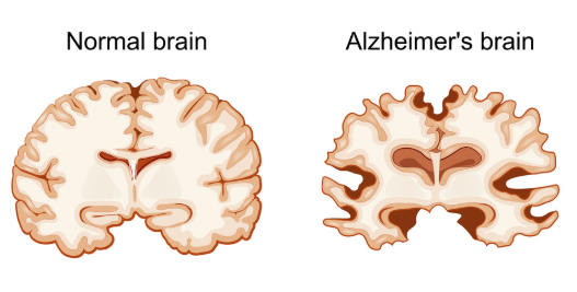 Studies find people are suffering from Alzheimer's disease